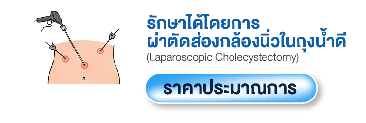 การรักษานิ่วในถุงน้ำดี (LC) และนิ่วในท่อน้ำดี (ERCP) ด้วยเทคนิคผ่าตัดส่องกล้อง