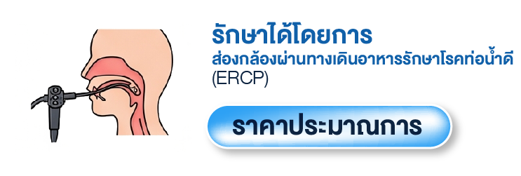 การรักษานิ่วในท่อน้ำดี (ERCP) ด้วยเทคนิคผ่าตัดส่องกล้อง
