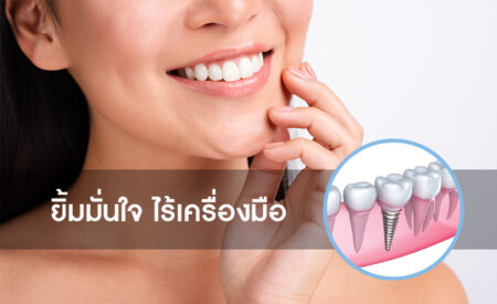 โปรโมชั่นรากฟันเทียม