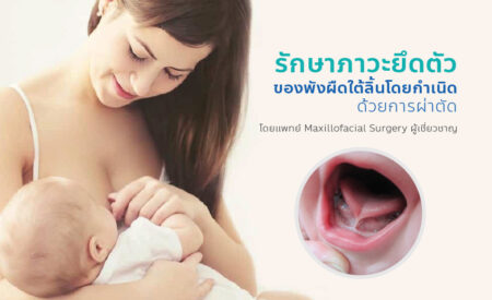 รักษาภาวะยึดตัวของพังผืดใต้ลิ้นโดยกำเนิด